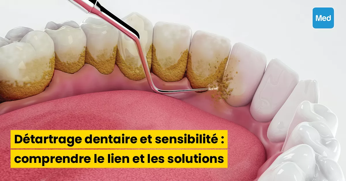 Détartrage dentaire et sensibilité : comprendre le lien et les solutions